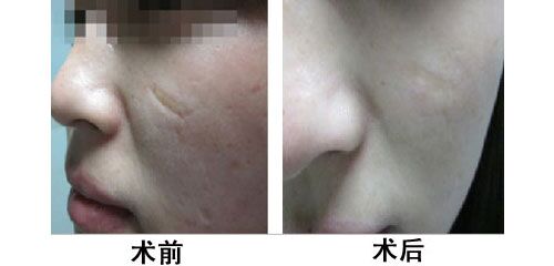 最新激光治疗技术，重塑凹陷疤痕，开启美丽新篇章